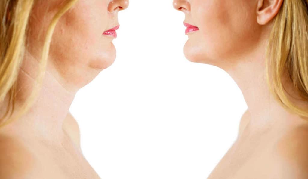 Double Chin treatment King's Cross before and after results