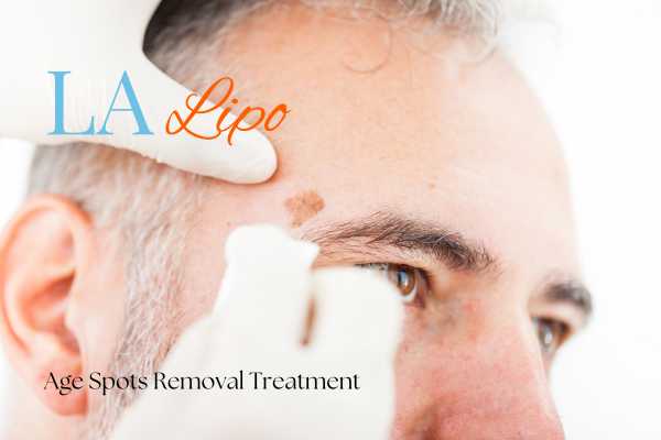What Are the Most Effective Treatments for Age Spots King's Cross?