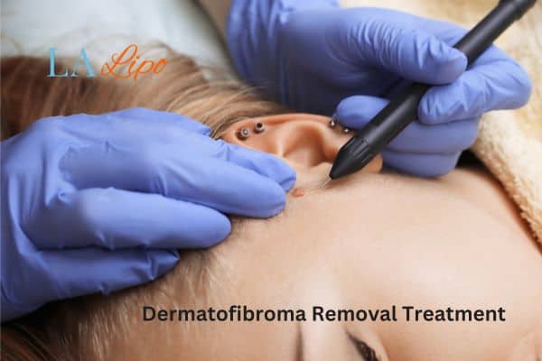 Dermatofibroma Removal Treatment King's Cross