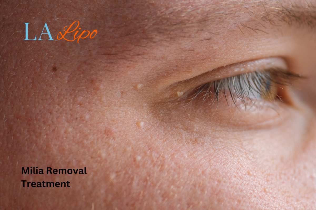 Cryopen Milia Removal: Is It the Easiest and Safest Option King's Cross?
