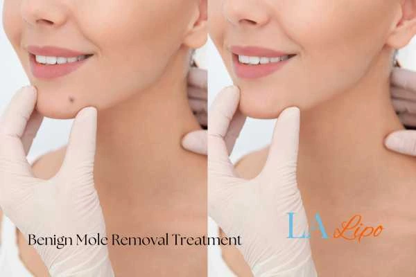 woman's before and after mole removal King's Cross results