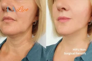 hi-fu for wrinkles King's Cross before and after results