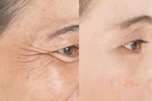 Before and after results of woman - HI-fu wrinkles reduction treatment King's Cross