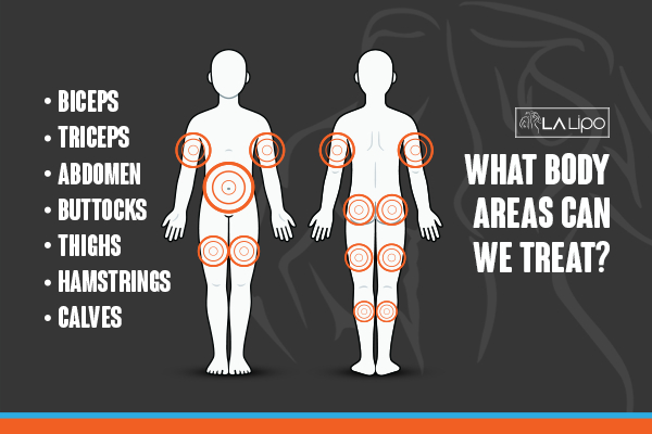 Graphic to show areas you can have LA-EMS Body Sculpting King's Cross treatment.