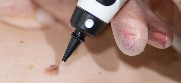 skin tag removal using cryopen King's Cross