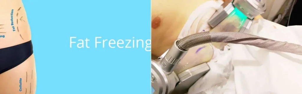 Fat freezing King's Cross on multiple areas of the body