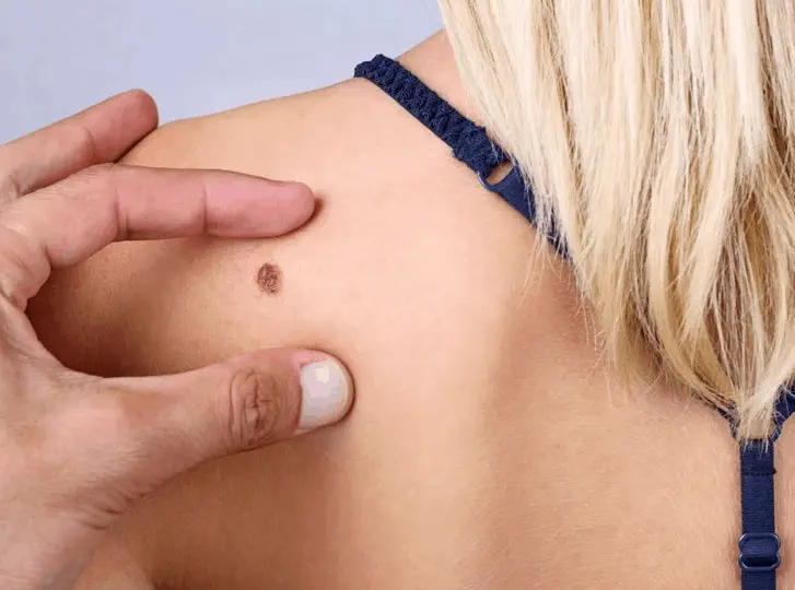 woman having mole removal King's Cross consultation before treatment.
