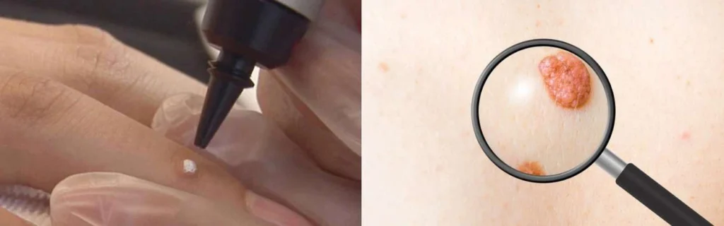 CryoPen practitioner King's Cross assessing a benign mole before treatment