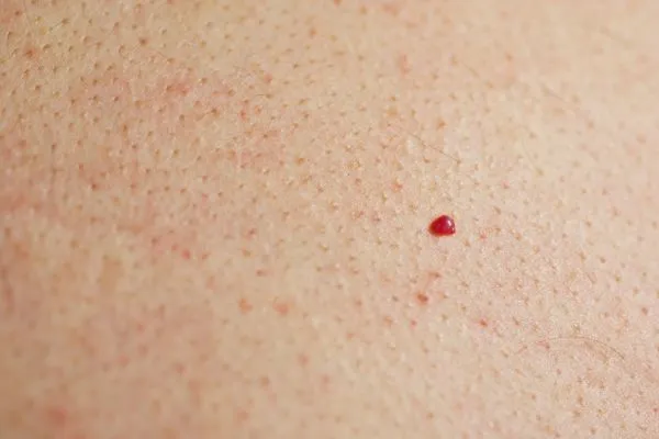 close up of a cherry angioma King's Cross