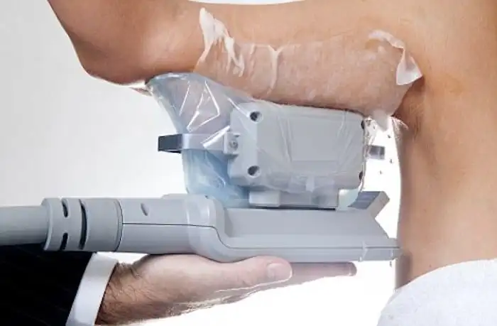Picture of fat freezing King's Cross on the upper arms.