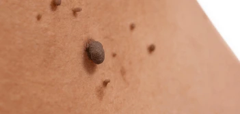image of a skin tag King's Cross
