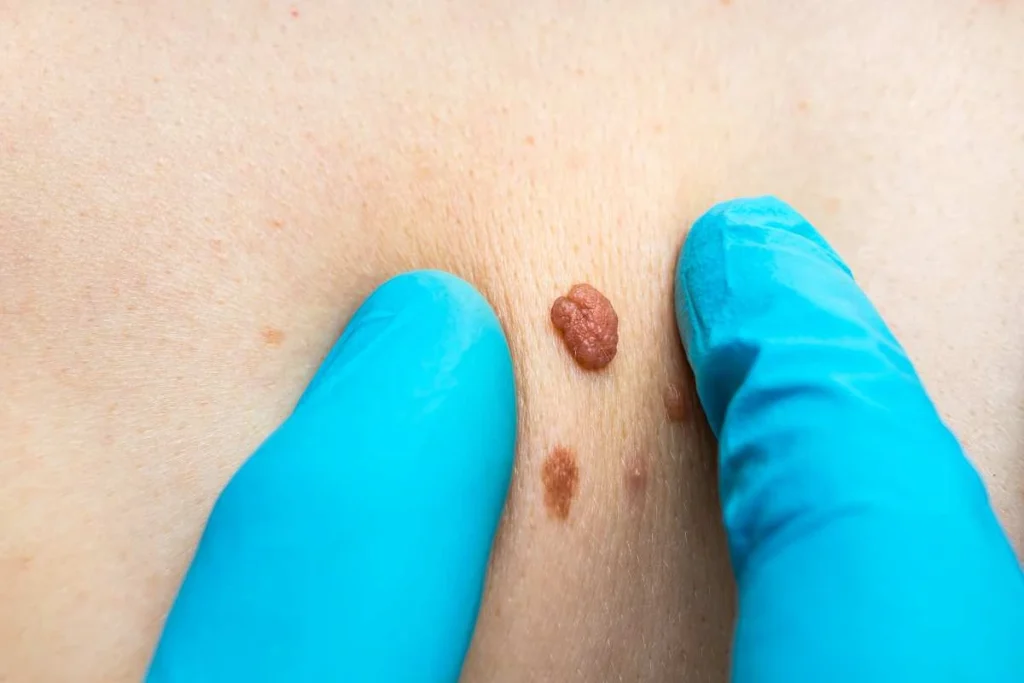 Consultant examining a skin tag King's Cross