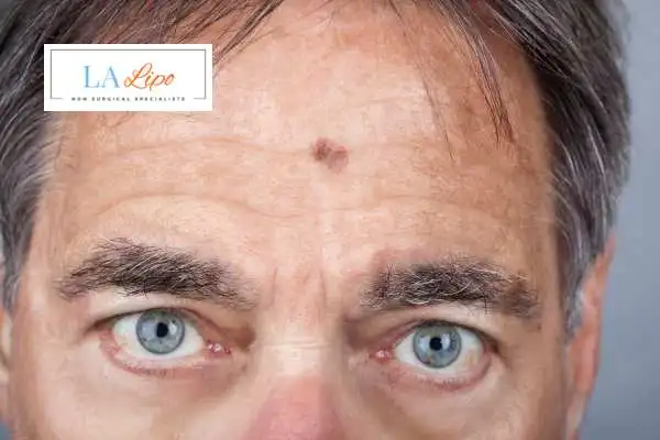 Solar Lentigo Removal King's Cross image of man with mark on his forehead