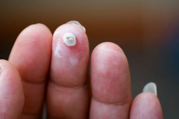 wart on person finger - cryotherapy to treat from LA LIPO King's Cross