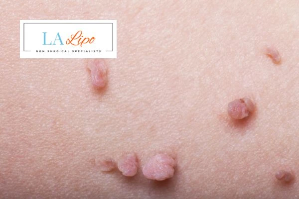 Does cryopen skin tag removal King's Cross hurt? Find out now call our team today!