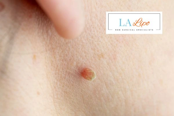 Book skin tag removal King's Cross today speak to our team now!