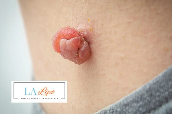 Interested in skin tag removal King's Cross? Concerned about the pain? Find out more today!