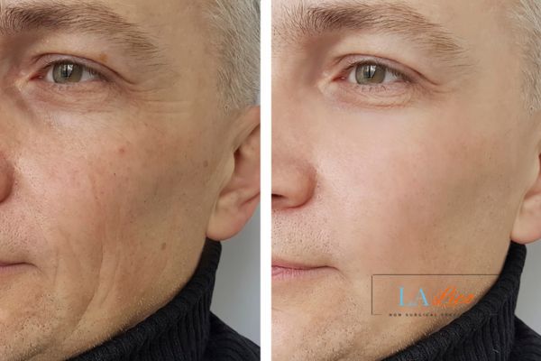 See the amazing results of Morpheus8 Treatment King's Cross!