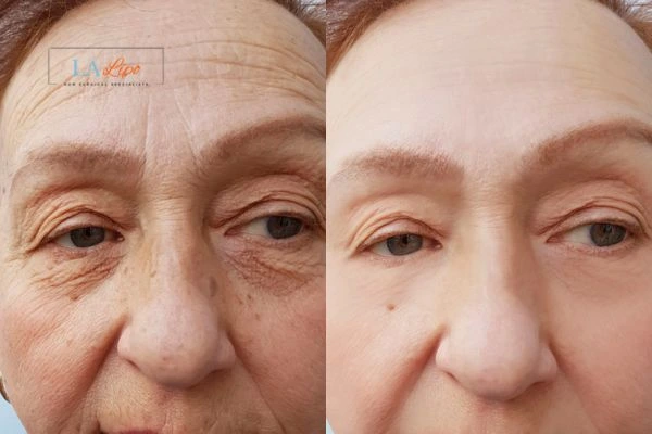 The powerful benefits of Morpheus8 Treatment King's Cross - Call Our team today!