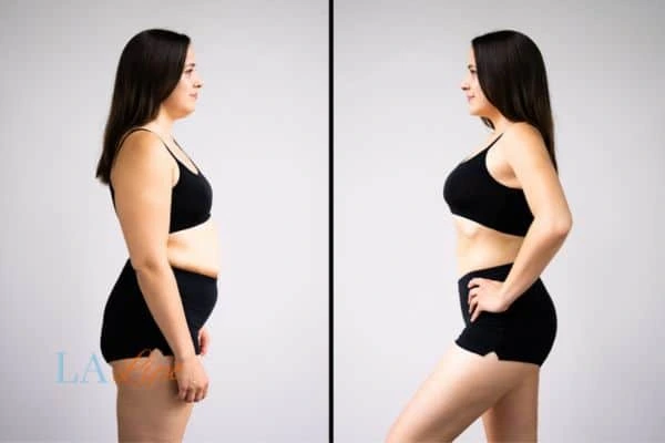 Picture of womans before and after using LA-EMS body sculpting to improve her core strength King's Cross