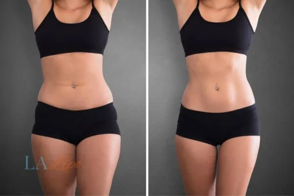 before and after results of non-surgical treatment to help a woman's body image and mental health King's Cross