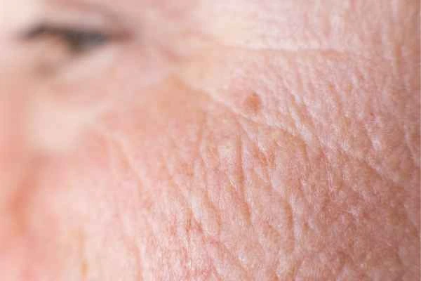 close up picture of a woman's face showing an age spot King's Cross