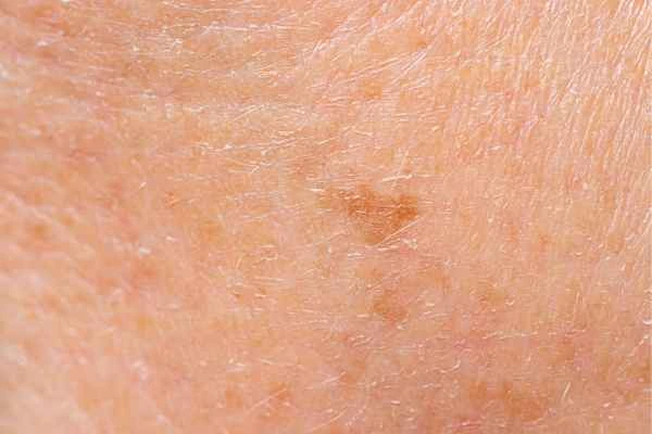 close up picture of age spots King's Cross