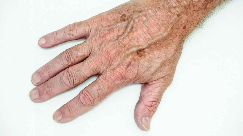 Male hand showing age spot King's Cross