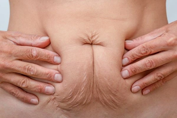 Should I Combine Diastasis Recti Treatment with Body Contouring for Better Results King's Cross?