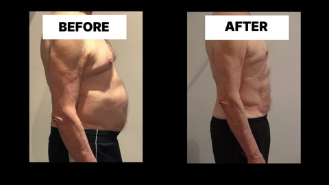 What Symptoms Can Diastasis Recti Cause in Men? Weak Core, Back Pain and Poor Posture King's Cross